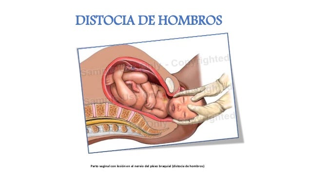 distocias de hombros